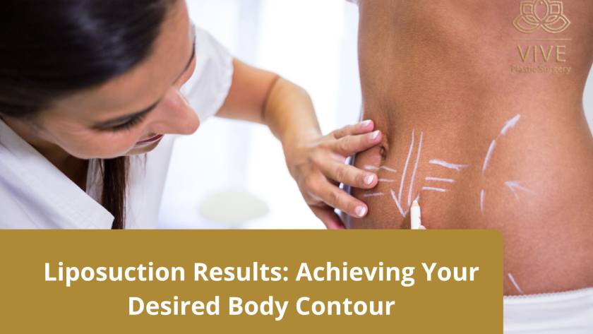 A female medical professional marking a patient's waist with white lines, outlining the targeted areas for liposuction.