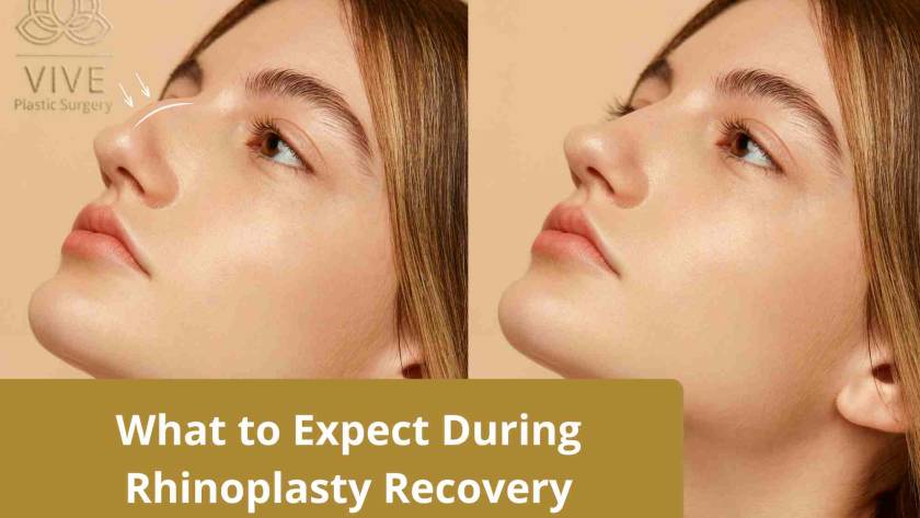 Before and after rhinoplasty recovery showcasing nose reshaping results at Vive Plastic Surgery, Tijuana.