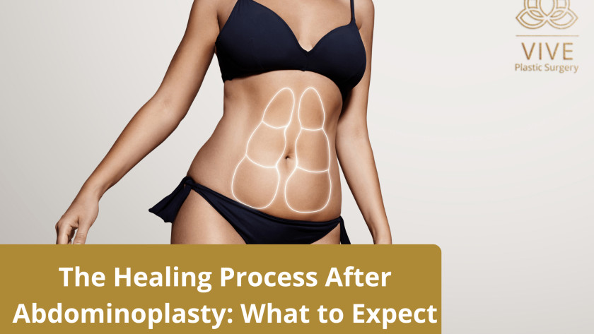 Woman showing abdominal contouring lines, illustrating the healing process after abdominoplasty at VIVE Plastic Surgery in Tijuana.