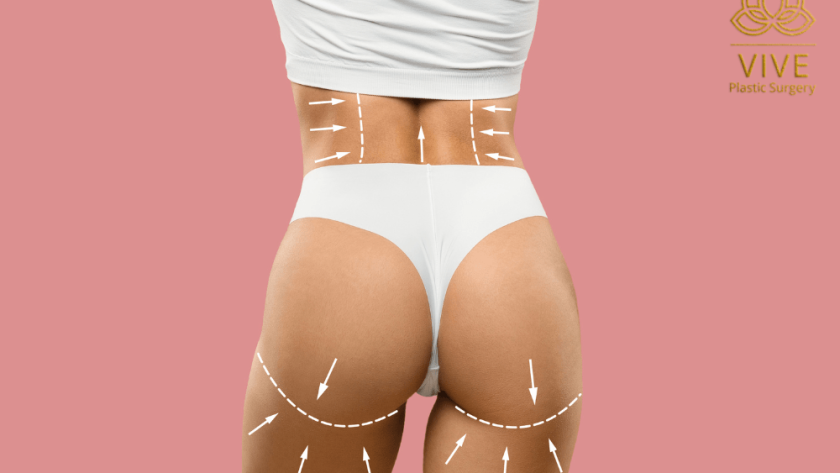 Illustration of body contouring and Brazilian Butt Lift (BBL) procedure at VIVE Plastic Surgery, enhancing curves and achieving an hourglass figure.