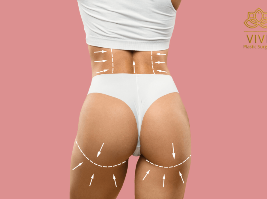 Illustration of body contouring and Brazilian Butt Lift (BBL) procedure at VIVE Plastic Surgery, enhancing curves and achieving an hourglass figure.