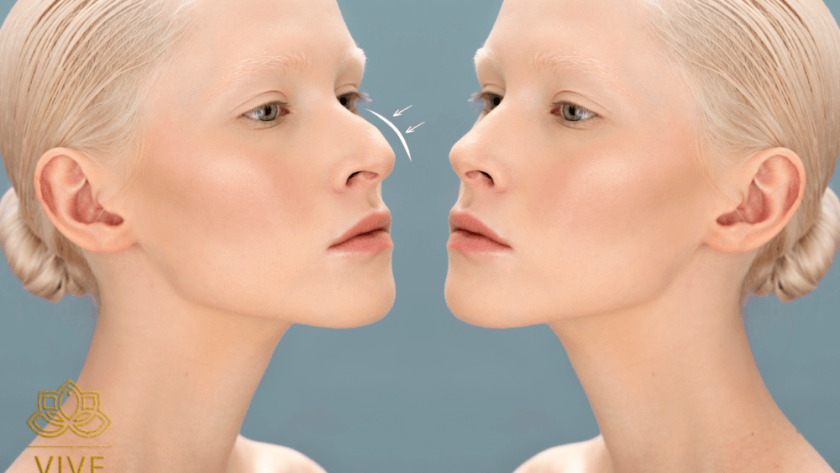Before and after rhinoplasty comparison showing nose reshaping in Tijuana