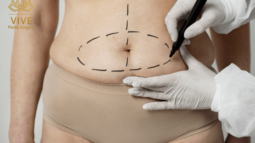 Tummy tuck preparation with abdominal markings before abdominoplasty in Tijuana