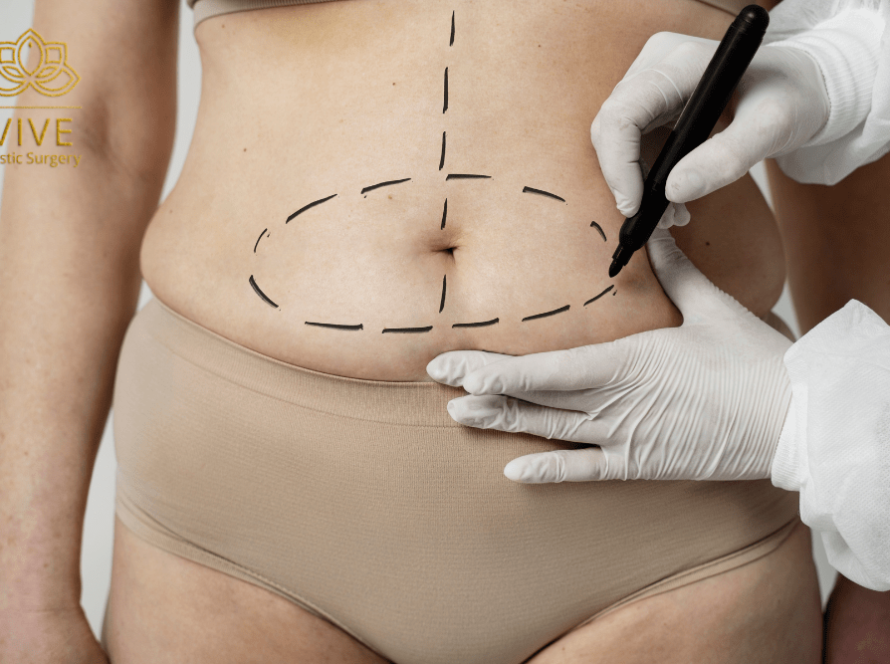 Tummy tuck preparation with abdominal markings before abdominoplasty in Tijuana