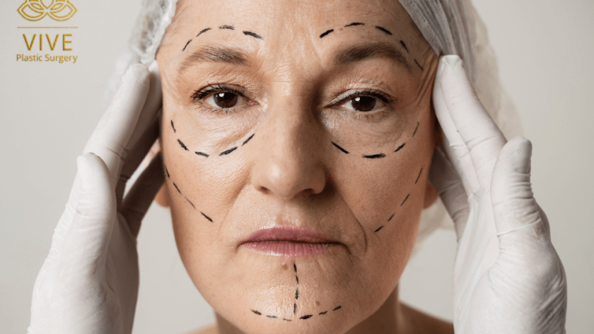 Mature woman with facial surgery markings preparing for facelift in Tijuana