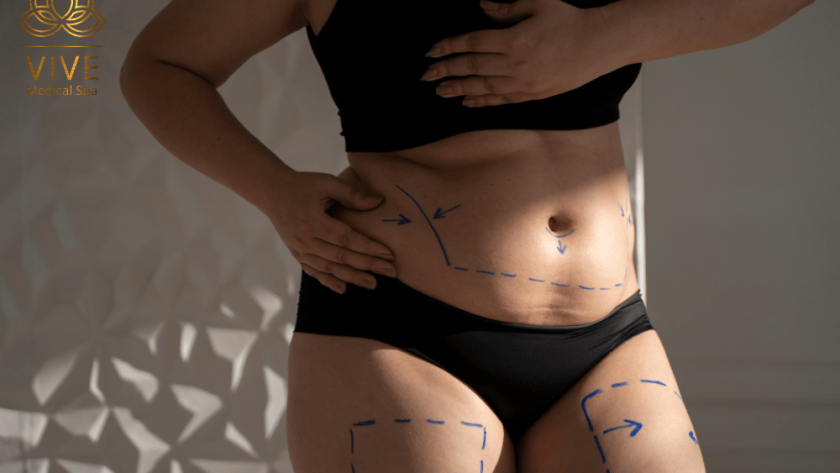 Woman body contouring marks for liposuction and tummy tuck in Tijuana