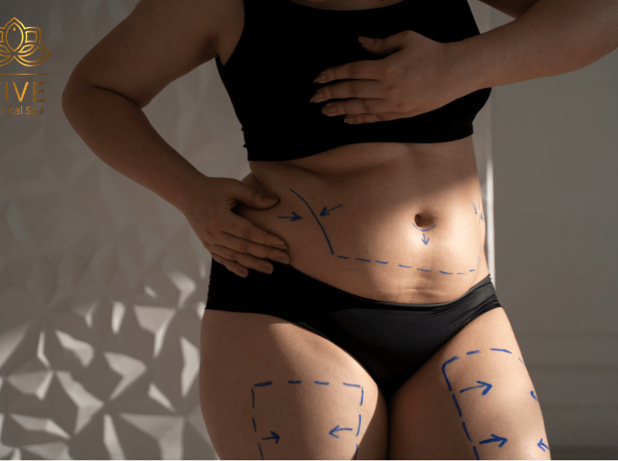 Woman body contouring marks for liposuction and tummy tuck in Tijuana