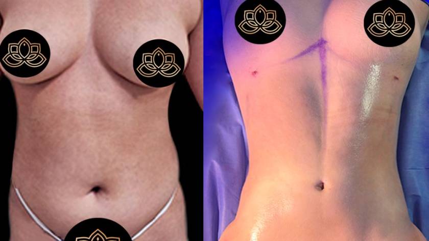 Female liposuction before and after results in Tijuana