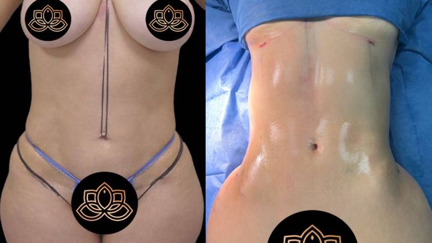 Female Lipo 360 before and after results in Tijuana