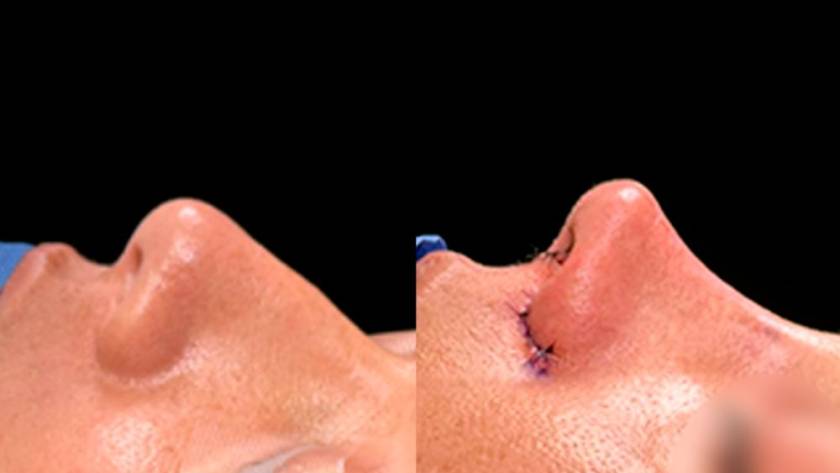Rhinoplasty before and after side profile results in Tijuana