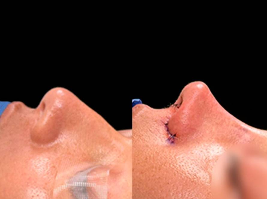 Rhinoplasty before and after side profile results in Tijuana