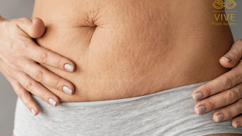 Loose abdominal skin and stretch marks before tummy tuck in Tijuana