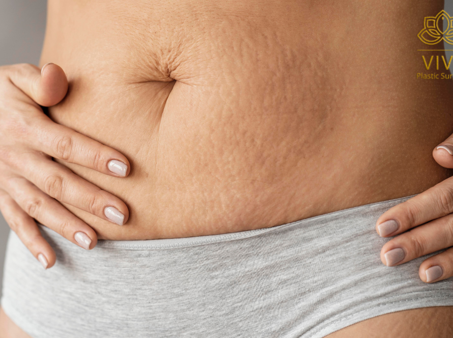 Loose abdominal skin and stretch marks before tummy tuck in Tijuana