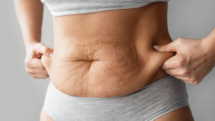 Woman showing excess abdominal skin before tummy tuck – catalog image, not a real patient
