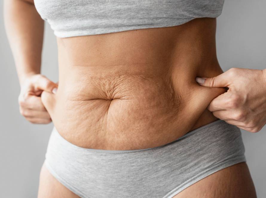 Woman showing excess abdominal skin before tummy tuck – catalog image, not a real patient