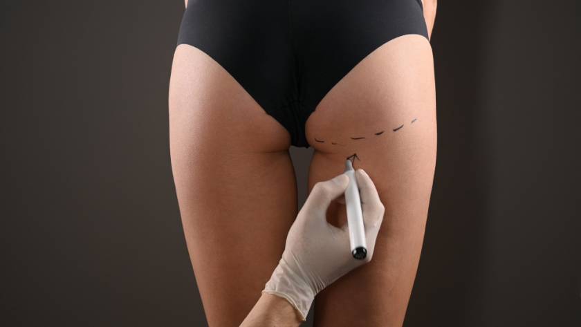 Surgeon drawing marks for BBL and gluteal contouring in Tijuana