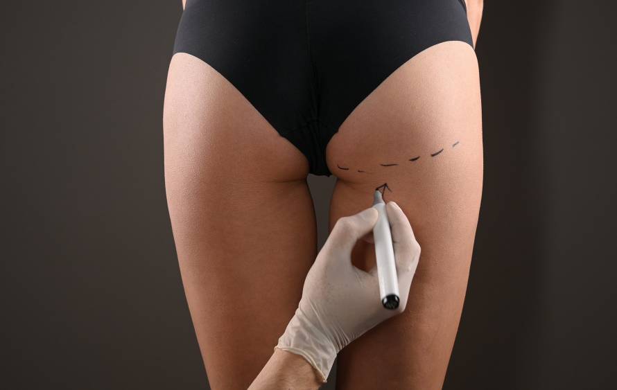 Surgeon drawing marks for BBL and gluteal contouring in Tijuana