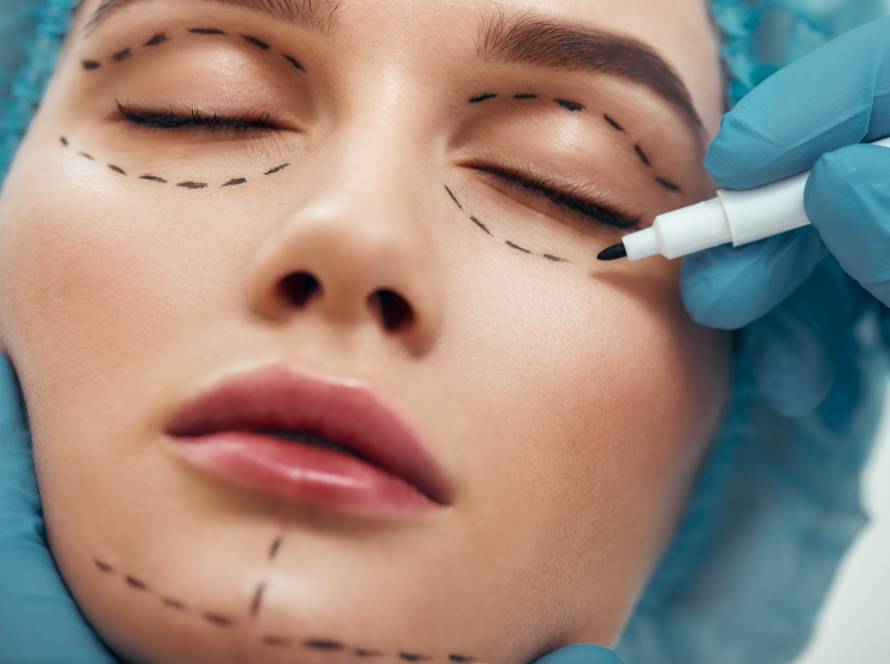 Surgeon marking face before eyelid and facelift surgery in Tijuana